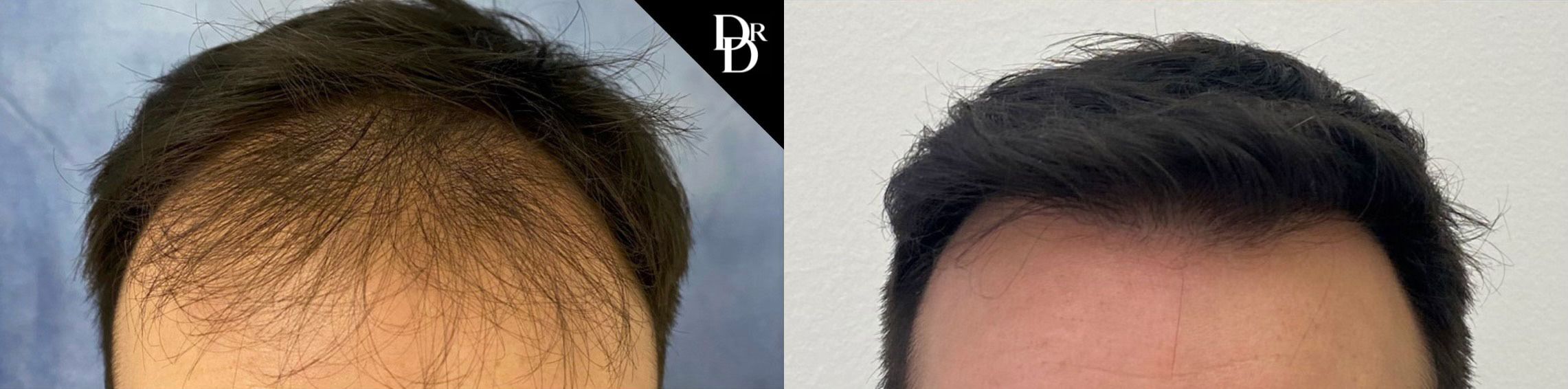 Hair Transplant Before and After Photo by Dr. Demetri in Beverly Hills California