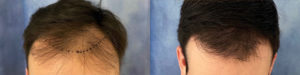 Hair Transplant Before and After Photo by Dr. Demetri in Beverly Hills California