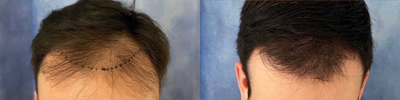 Hair Transplant Before and After Photo by Dr. Demetri in Beverly Hills California
