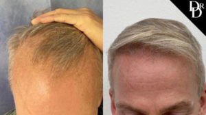 Hair Transplant Before and After Photo by Dr. Demetri in Beverly Hills California