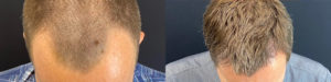 Hair Transplant Before and After Photo by Dr. Demetri in Beverly Hills California