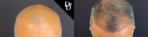 Hair Transplant Before and After Photo by Dr. Demetri in Beverly Hills California