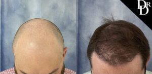 Hair Transplant Before and After Photo by Dr. Demetri in Beverly Hills California