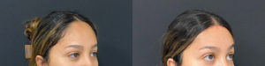 Hairline Lowering Before and After Photo by Dr. Demetri in Beverly Hills California