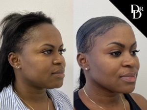 Hairline Lowering Before and After Photo by Dr. Demetri in Beverly Hills California
