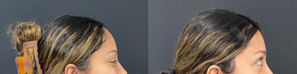 Hairline Lowering Before and After Photo by Dr. Demetri in Beverly Hills California
