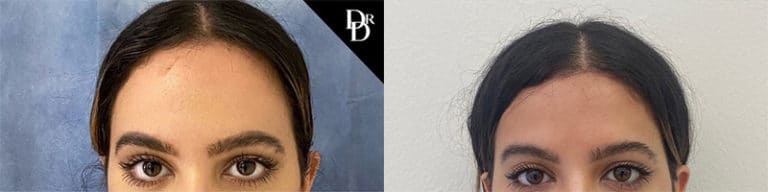 Hairline Lowering Before and After Photo by Dr. Demetri in California Hairline Lowering Before and After Photo by Dr. Demetri in California