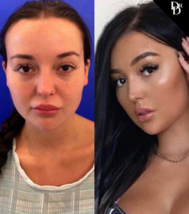 Hairline Lowering Before and After Photo by Dr. Demetri in Beverly Hills California