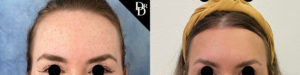 Hairline Lowering Before and After Photo by Dr. Demetri in Beverly Hills California