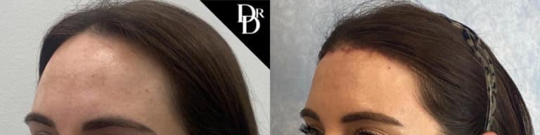 Hairline Lowering Before and After Photo by Dr. Demetri in California Hairline Lowering Before and After Photo by Dr. Demetri in California