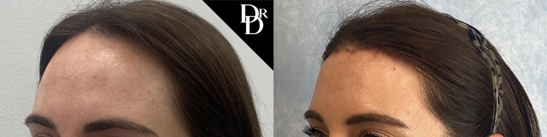 Hairline Lowering Before and After Photo by Dr. Demetri in Beverly Hills California