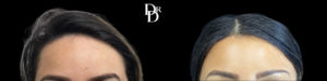 Hairline Lowering Before and After Photo by Dr. Demetri in Beverly Hills California