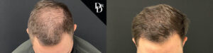 Hair Transplant Before and After Photo by Dr. Demetri in Beverly Hills California