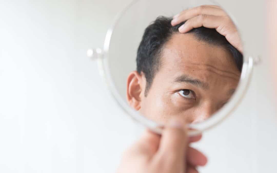 Men are worried about hair loss