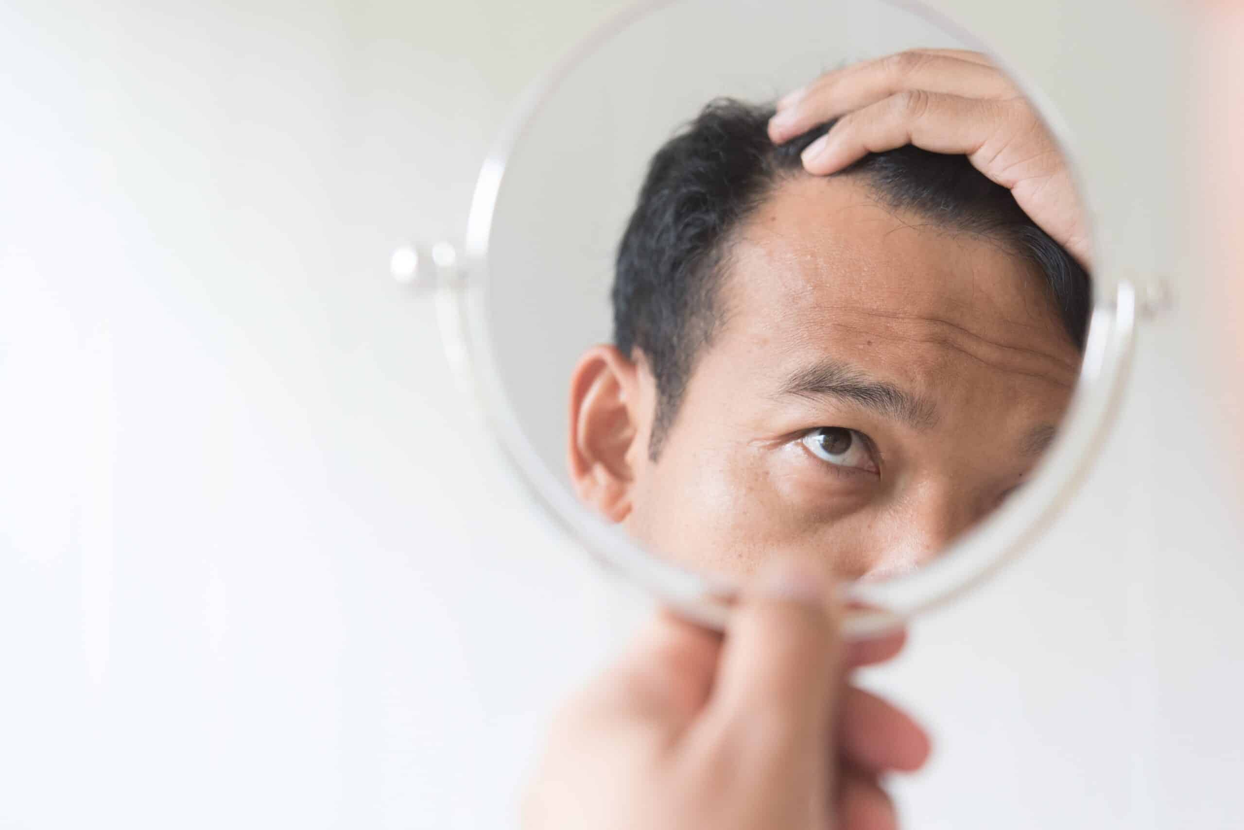 Men are worried about hair loss