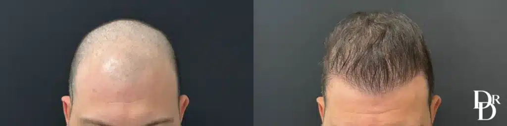 Hair Transplant Before and After Photo by Dr. Demetri in Beverly Hills California