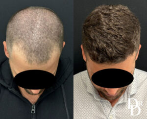 Hair Transplant Before and After Photo by Dr. Demetri in Beverly Hills California
