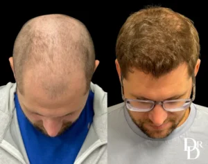Hair Transplant Before and After Photo by Dr. Demetri in Beverly Hills California