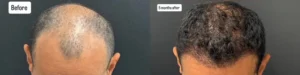 Hair Transplant before and after photos by Dr. Demetri Arnaoutakis in Tampa, FL