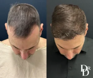Male Hair Transplant before and after photos by Dr. Demetri Arnaoutakis in Tampa, FL