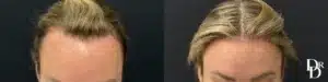 Front View Hair Transplant before and after photos by Dr. Demetri