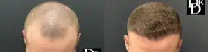 Hair Transplant Before and After Photo by Dr. Demetri