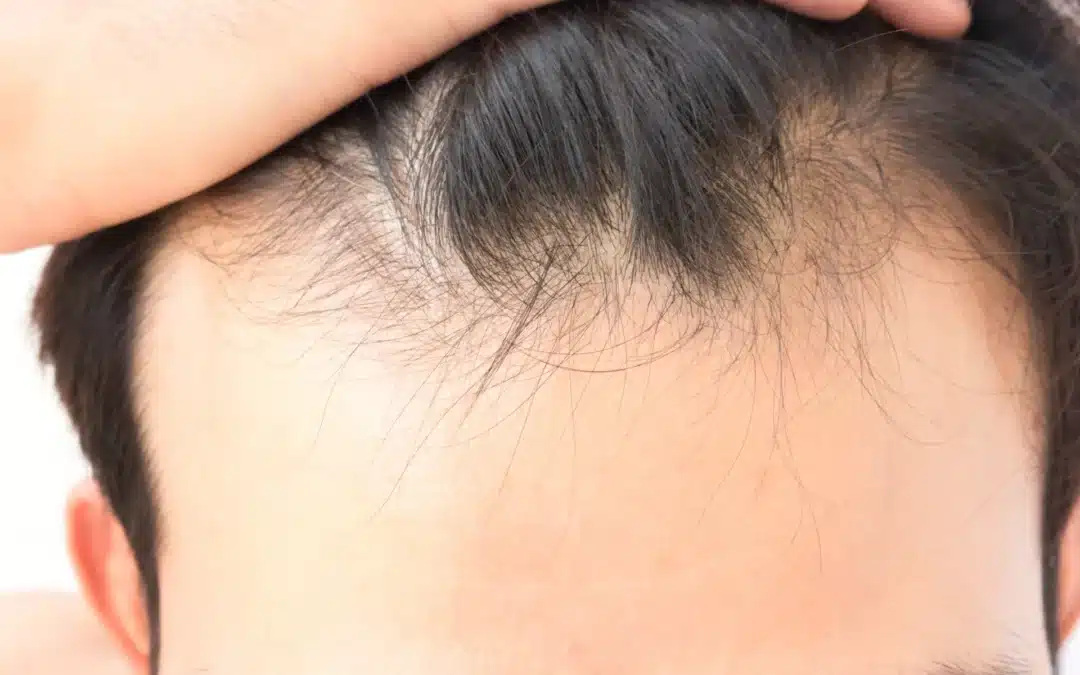 young man worry hair loss problem