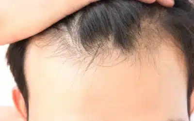 How WAW FUE Technology Improves Graft Survival and Natural Results