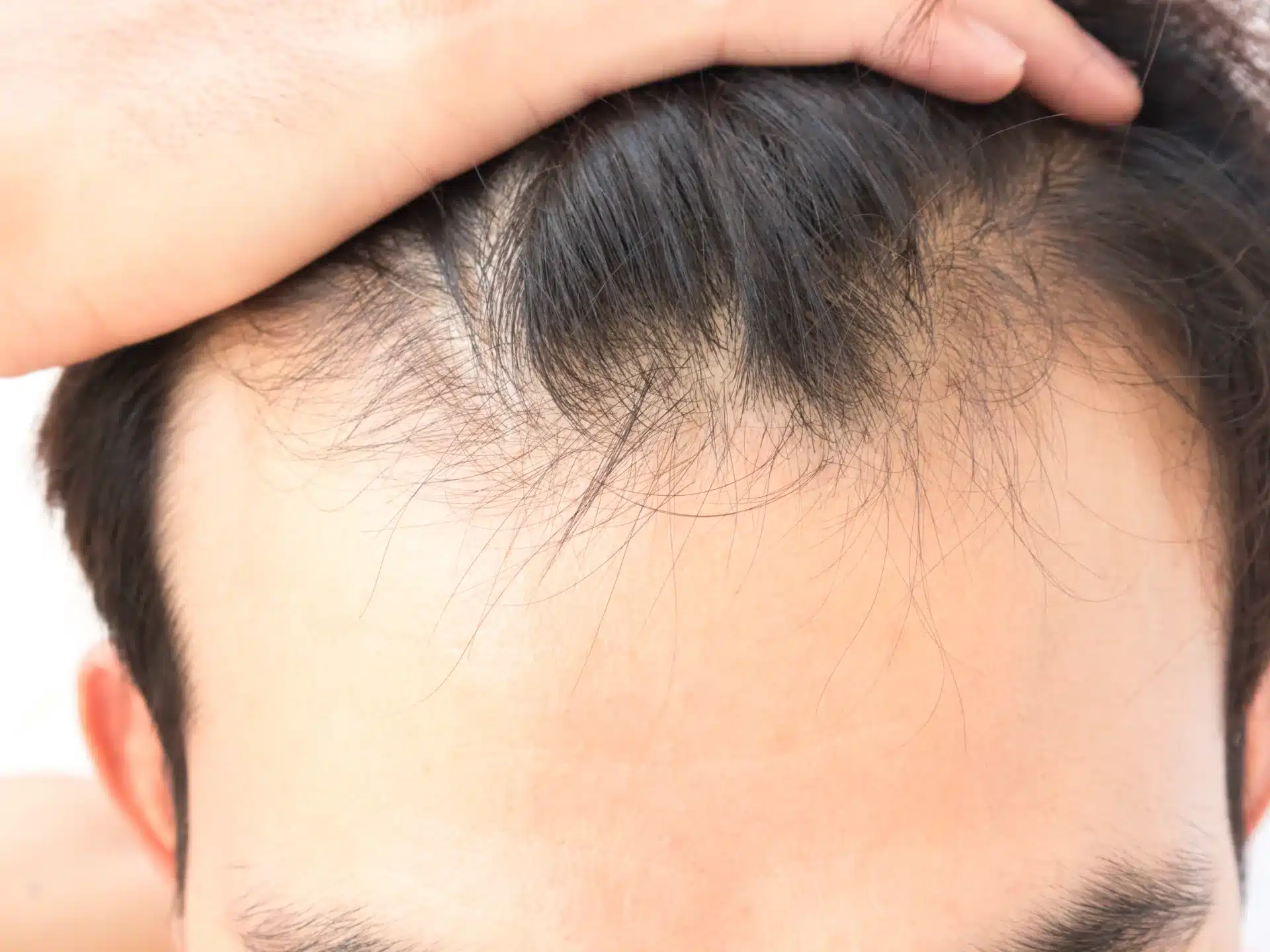 young man worry hair loss problem