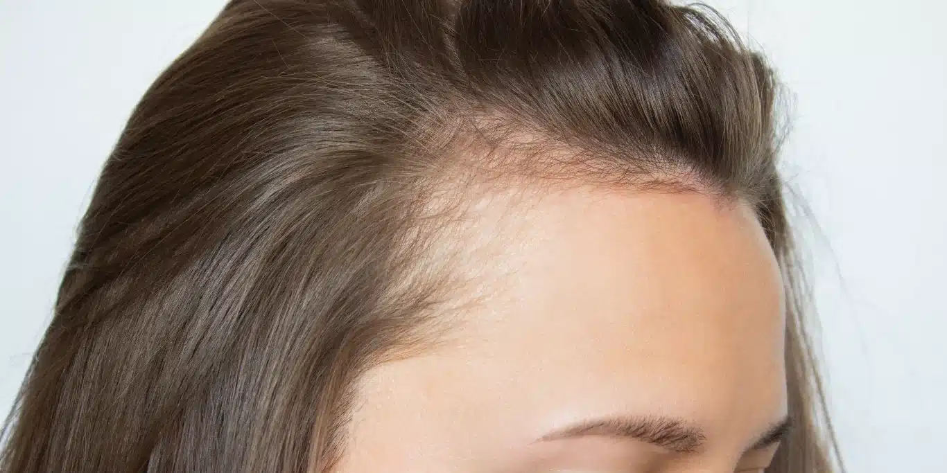 woman with receding hairline on her forehead and temples